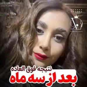 جراحی-بینی-122