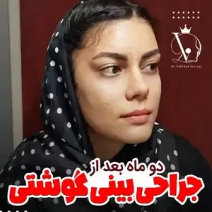 جراحی-بینی-125