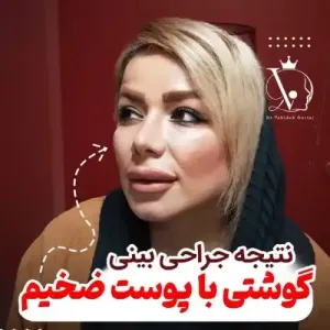 جراحی-بینی-128