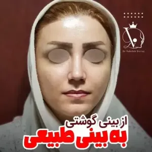 جراحی-بینی-129