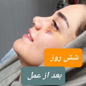 جراحی-بینی-135