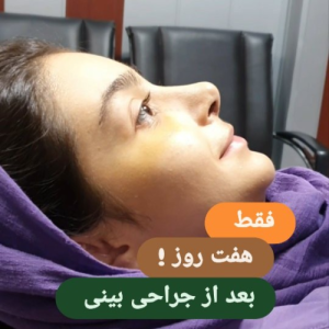 جراحی-بینی-136