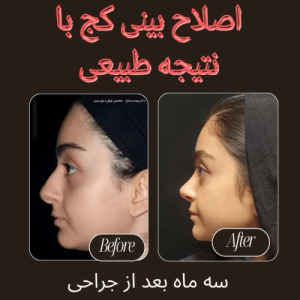 جراحی-بینی-141