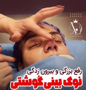 جراحی-بینی-143