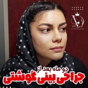 جراحی-بینی-144