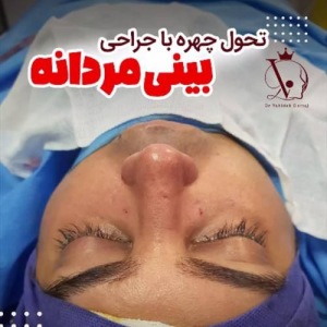 جراحی-بینی-146