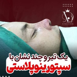 جراحی-بینی-148
