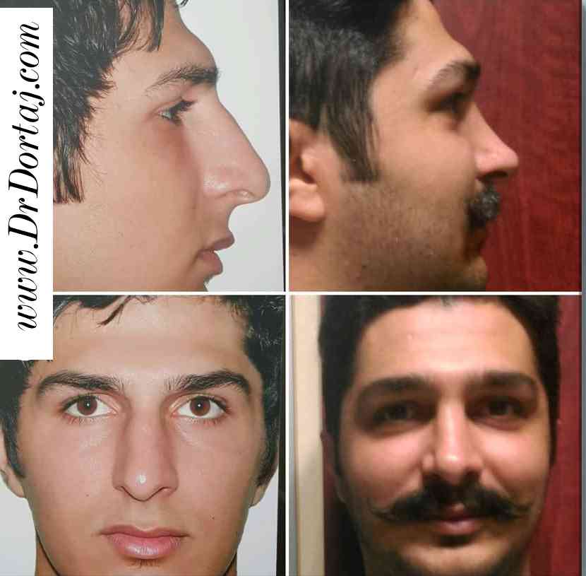 جراحی زیبایی بینی مردانه
