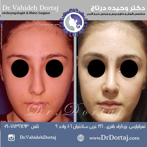 قبل و بعد از عمل بینی به شکل طبیعی