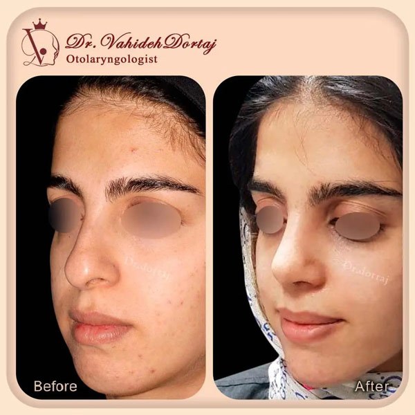 جراحی بینی استخوانی - دکتر وحیده درتاج در تهران