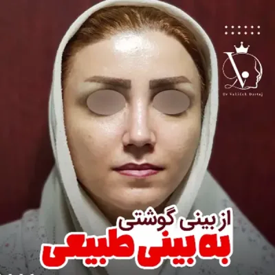 بهترین جراح بینی تهران _ دکتر وحیده درتاج