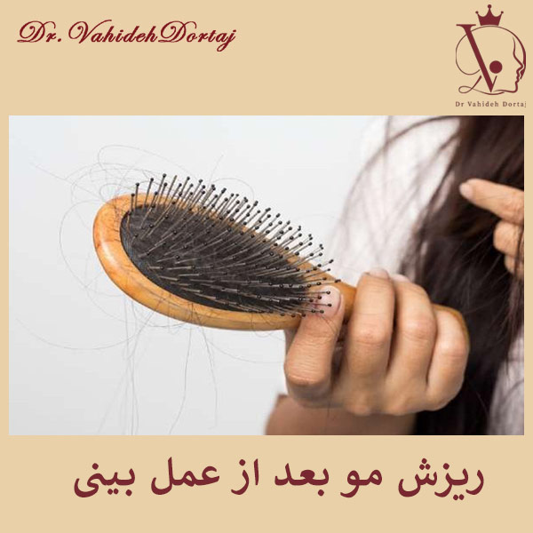 ریزش مو بعد از عمل بینی _ دکتر درتاج