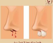 خون ریزی بعد از عمل بینی _ دکتر وحیده درتاج