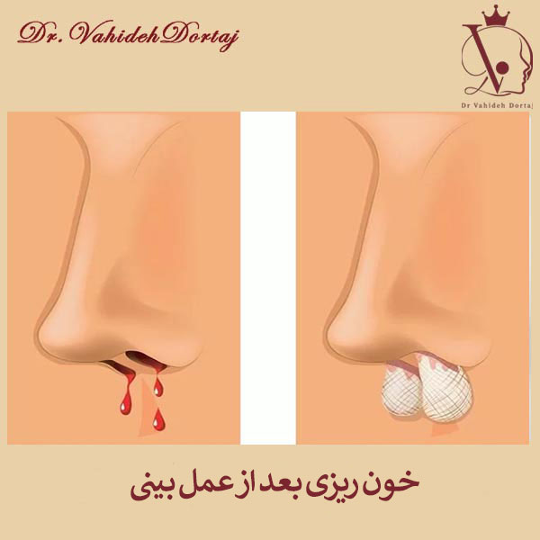 خون ریزی بعد از عمل بینی _ دکتر وحیده درتاج